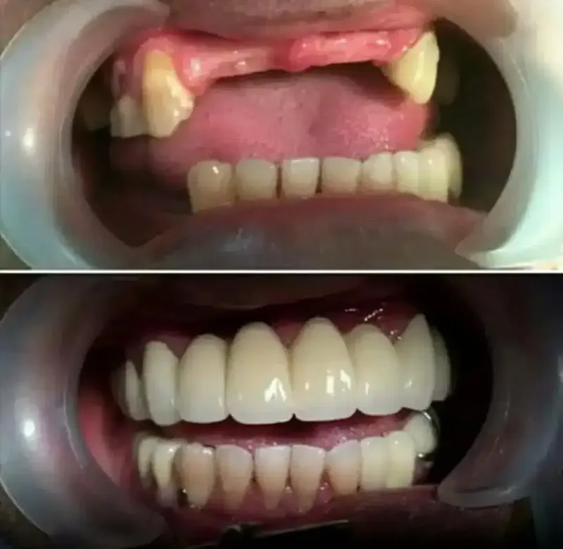 VALPLAST DAN AKRILIK NYAMAN DIPAKAI - Other in Bali