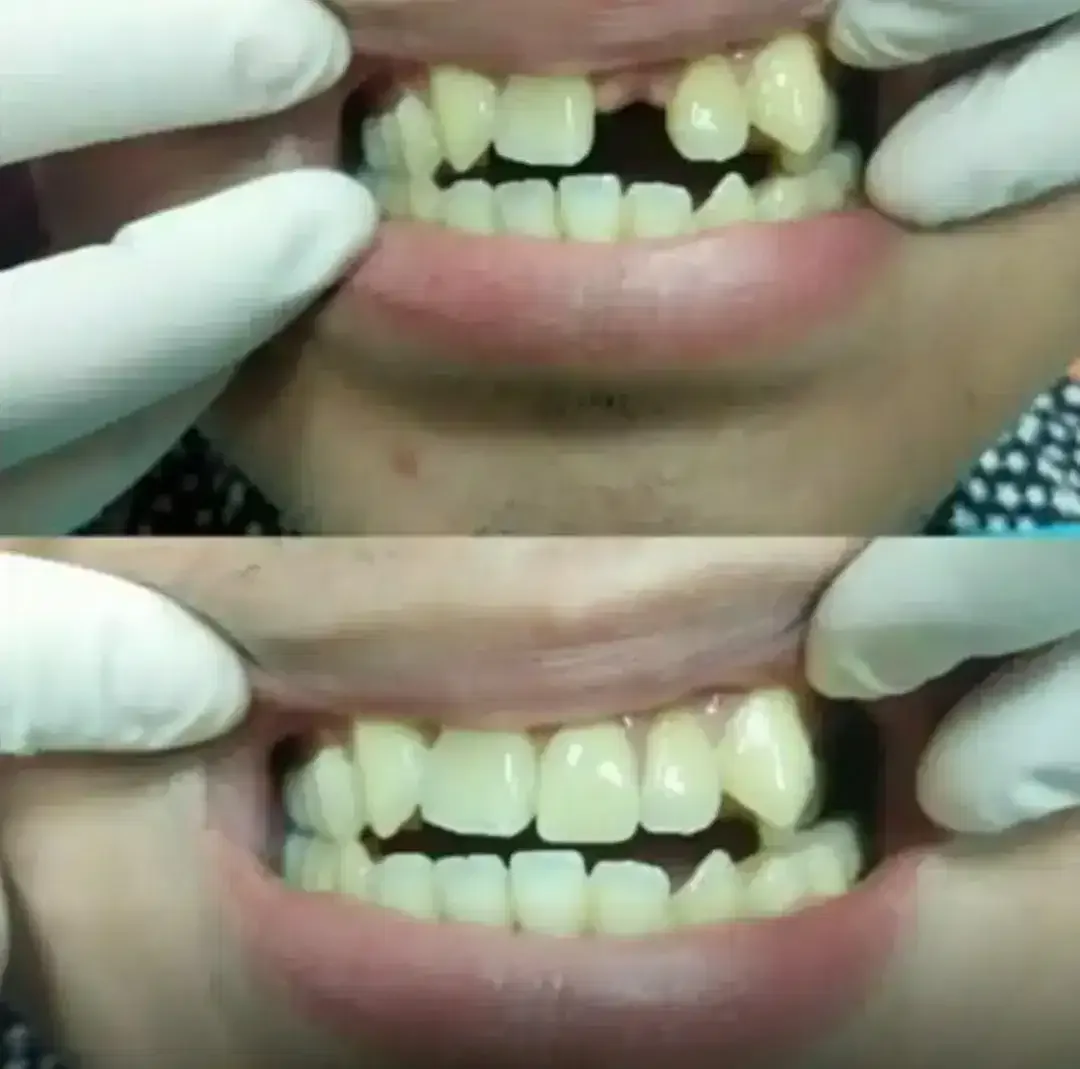 GIGI TIRUAN LEPASAN - Image 1 of 1