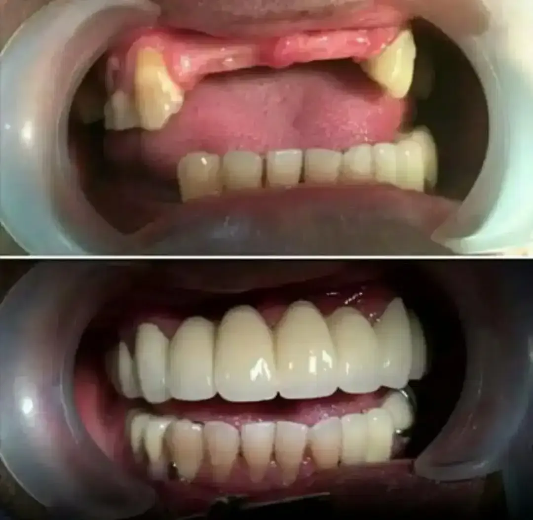 VALPLAST DAN AKRILIK NYAMAN DIPAKAI - Image 1 of 1